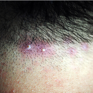 3. التهاب الجريبات 3. التهاب الجريبات