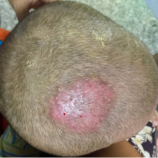 4. سعفة الرأس 4. سعفة الرأس