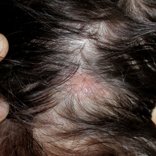 6. الحزاز المسطح 6. الحزاز المسطح