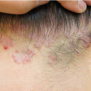 7. الذئبة الحمامية القرصية 7. الذئبة الحمامية القرصية