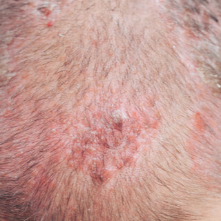 8. القوباء المنطقية أو الهربس النطاقي 8. القوباء المنطقية أو الهربس النطاقي