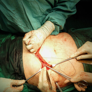 عملية التكميم جراحيًّا