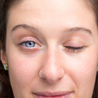 أنواع الجلوكوما أنواع الجلوكوما