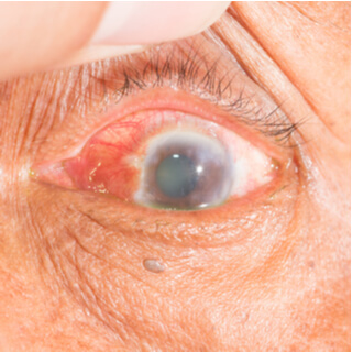 أنواع الجلوكوما أنواع الجلوكوما