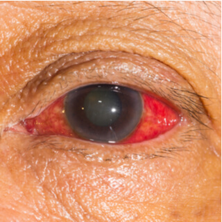 أعراض الجلوكوما أعراض الجلوكوما