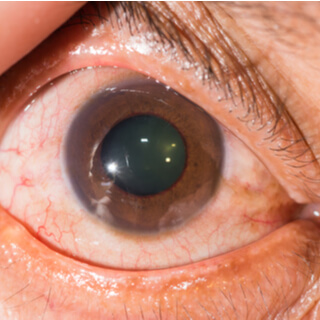 أسباب الجلوكوما أسباب الجلوكوما