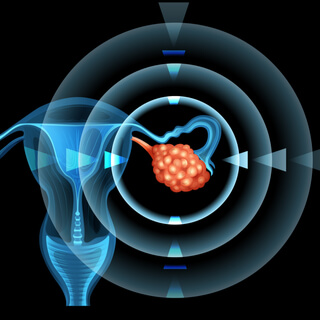 سرطان المبيض بالصور