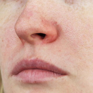 أعراض العد الوردي 