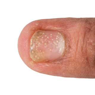 الفرق بين الإكزيما والصدفية في أماكن ظهورها