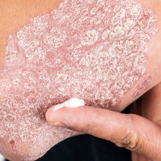 الفرق بين الإكزيما والصدفية في العلاج 