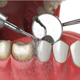 الخطوة الثانية: تنظيف الأسنان