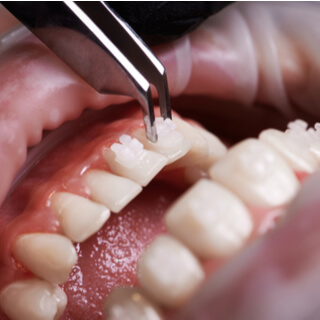 الخطوة الثالثة: لصق الأقواس (Brackets)