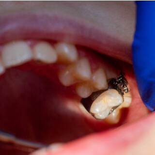 الخطوة الرابعة: وضع الحلقات الدائرية