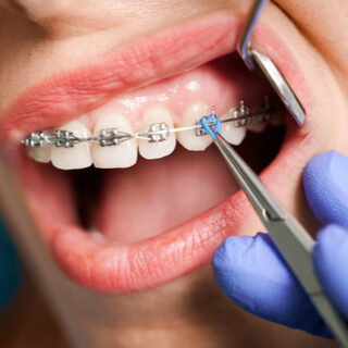 الخطوة الخامسة: وضع وتثبيت الأسلاك المقوسة 