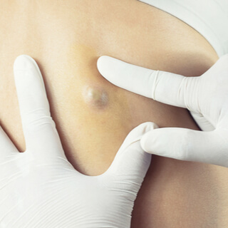 ما هو الكيس؟