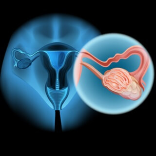 أسباب ظهور ورم على المبيض