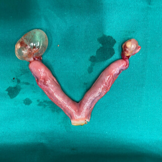 علاج كيس وورم المبيض المتقدّم