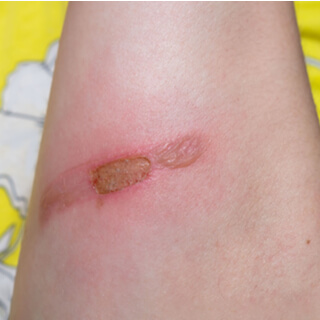 مضاعفات وضع الجبيرة  مضاعفات وضع الجبيرة