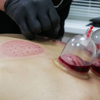 2. الحجامة الرطبة