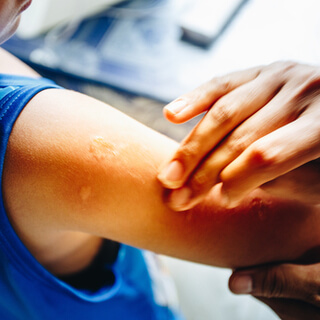 بالصور: طرق علاج لسعات الحشرات