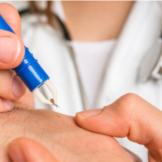 2- إزالة الحشرة أو الإبرة من الجلد