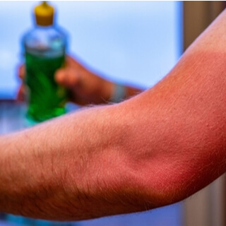 6. طريقة اسنخدام جل الصبار لحروق الشمس