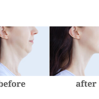 3. جراحة شد الوجه (Face-lift) 3. جراحة شد الوجه (Face-lift)