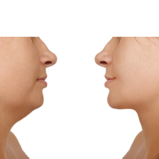 4. جراحة شد الرقبة Neck-lift 4. جراحة شد الرقبة Neck-lift