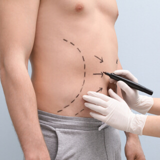 التحضير لإجراء عملية شد البطن