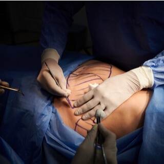 عملية شد البطن الجزئي أو المصغّر