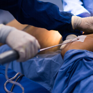 عملية شد البطن المحيطي