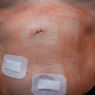 بعد إجراء عملية شد البطن