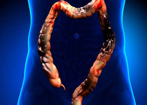 الوقاية من سرطان القولون