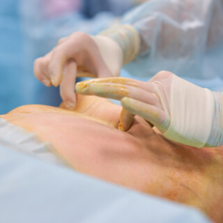 أثناء عملية إزالة الترهلات أثناء عملية إزالة الترهلات