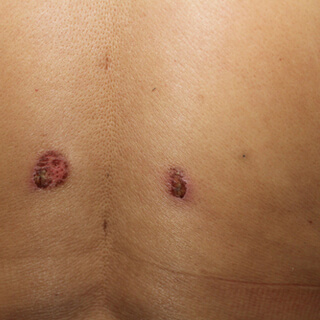 بعد إجراء عملية إزالة الترهلات بعد إجراء عملية إزالة الترهلات