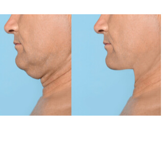 فوائد إجراء عملية إزالة الترهلات فوائد إجراء عملية إزالة الترهلات