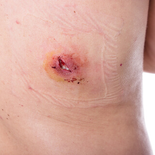 مضاعفات ومخاطر إجراء عملية إزالة الترهلات مضاعفات ومخاطر إجراء عملية إزالة الترهلات