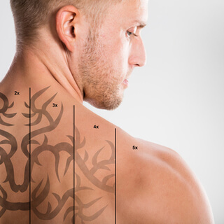 بالصور: إزالة التاتو بالليزر