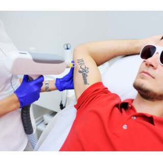 كيفية إزالة التاتو بالليزر