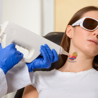 هل إزالة التاتو بالليزر آمنًا؟