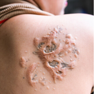 مخاطر إزالة التاتو بالليزر