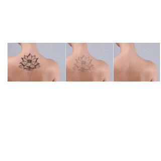 فوائد إزالة التاتو بالليزر