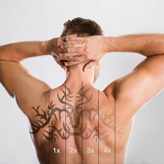 هل تتم إزالة التاتو بالليزر بشكل كامل؟