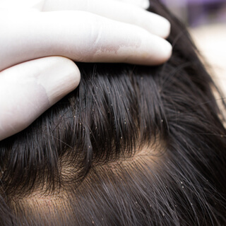 1. القمل (Lice)