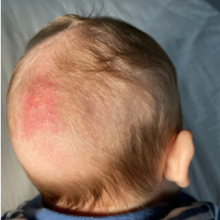 2. سعفة الرأس (Ringworm)