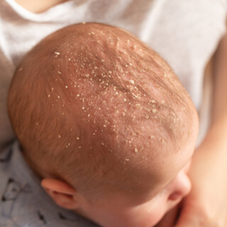 3. الأكزيما (Eczema)