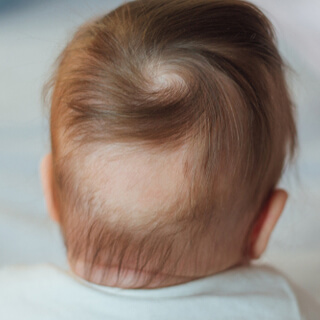 5. الثعلبة (Alopecia)