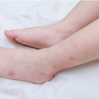 علاج لدغات حشرات الفراش منزليًا