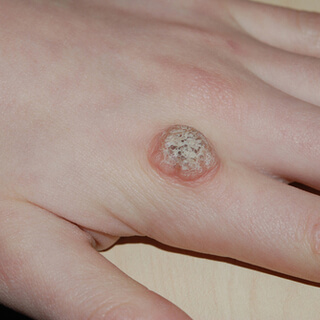 1. الثآليل الشائعة  (Common Warts)
