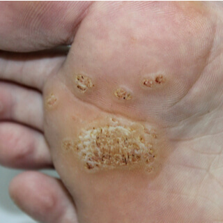 2. الثآليل الأخمصية (Plantar Warts)